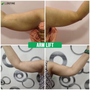 Arm Lift Surgery