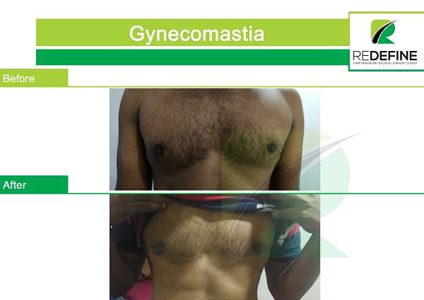 Before & After Gynecomastia Surgery