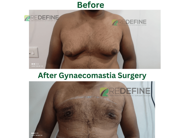 Before & After Gynecomastia Surgery