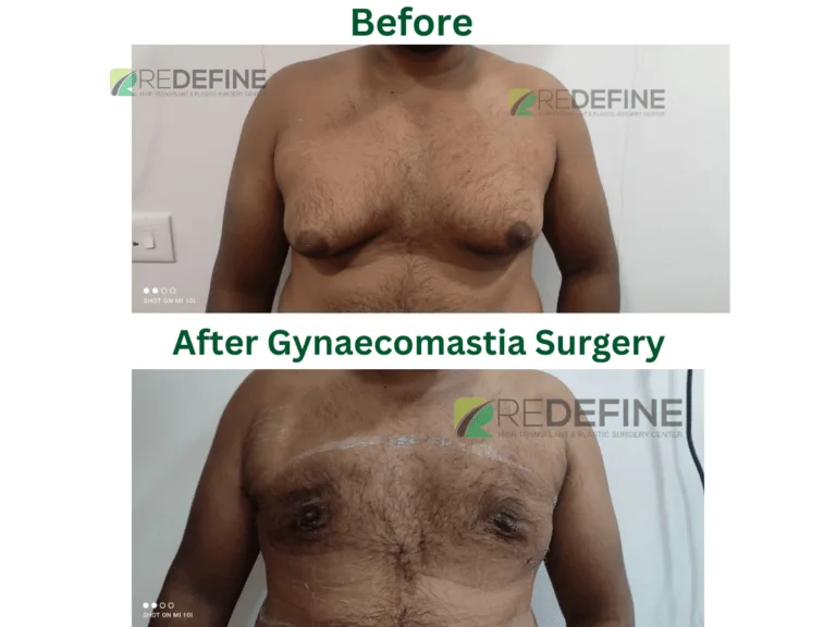 bpc 157 gyno Gynecomastia Surgery In Hyderabad - View Cost