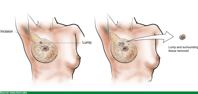 Fibroadenoma breast surgery 