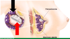 Fibroadenoma 