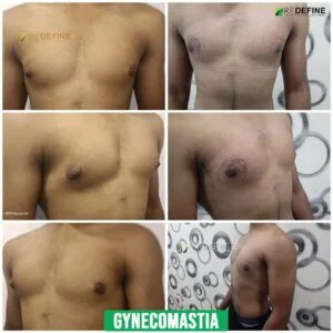 Gynecomastia surgery and chest gland correction illustration related to male breast tissue management