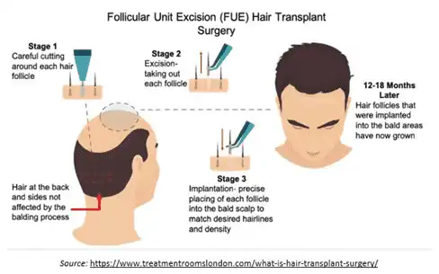 Hair transplantation