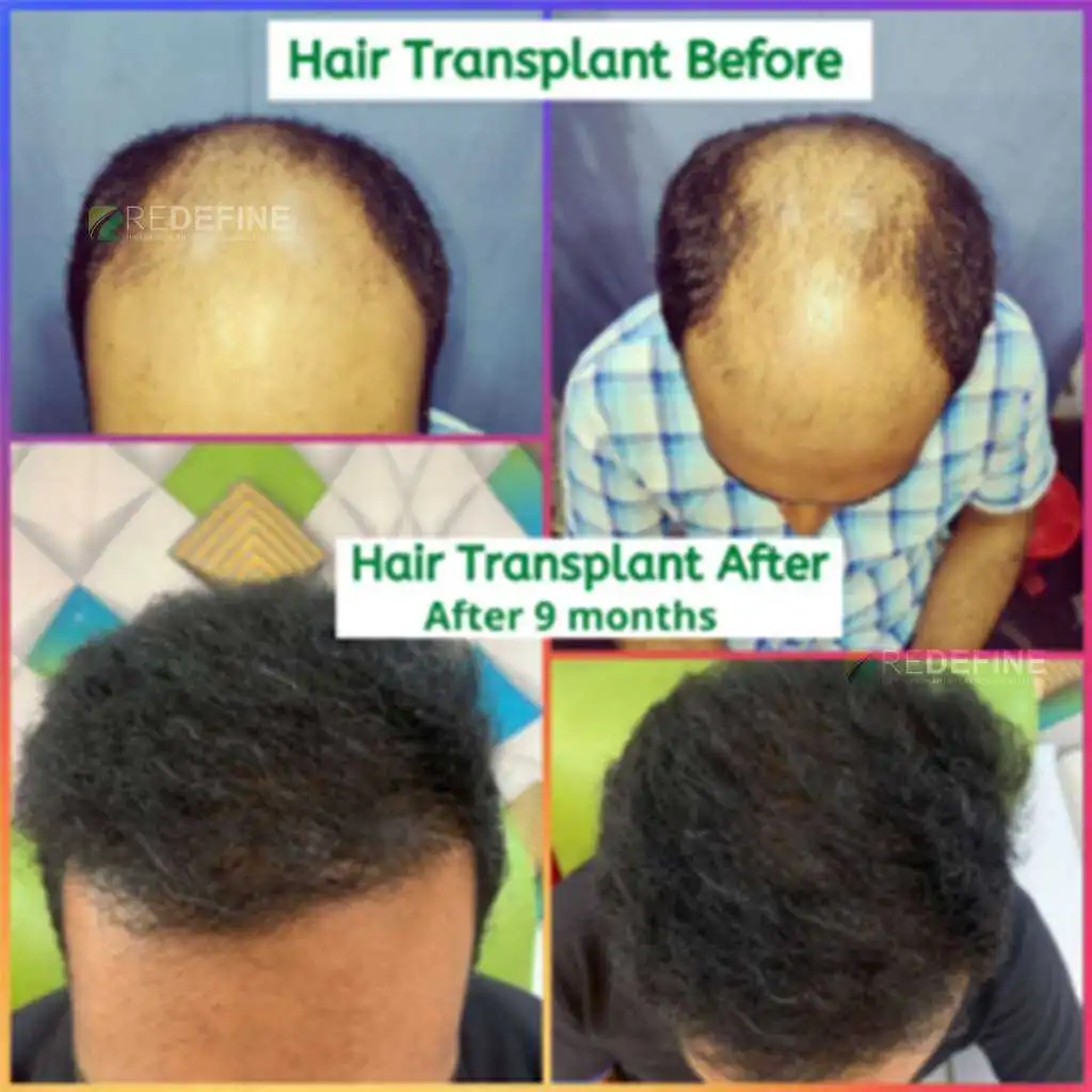 Hair Loss Treatment