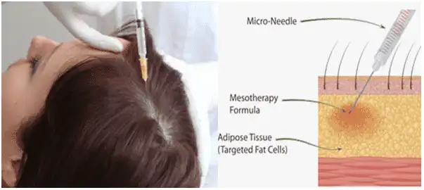 Hair Mesotherapy Performed