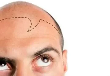 Does Hair Transplant Look Natural?