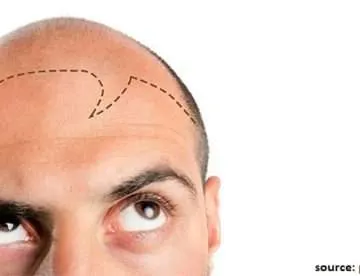 Hair-Transplant