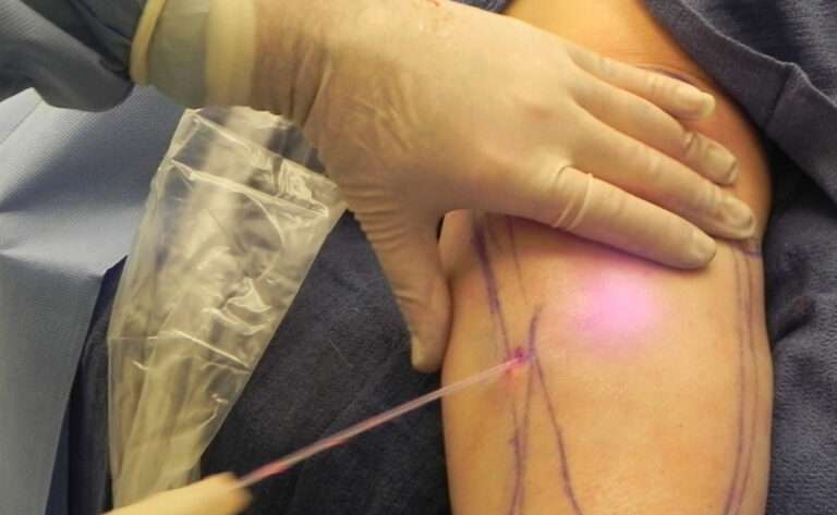 Laser Lipo