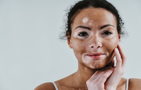 Melanocytes-Transfer-for-Vitiligo