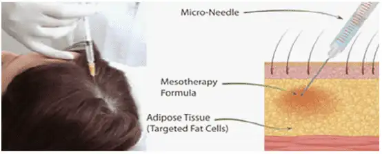 Mesotherapy