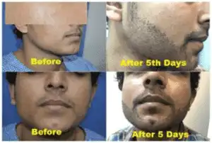 ReDefine Hair Transplant 