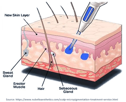 Scalp Micropigmentation