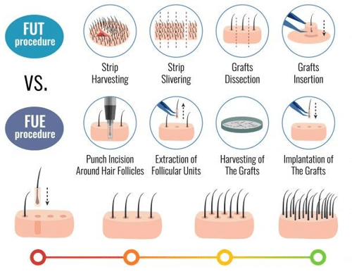 Transplanting the hair grafts