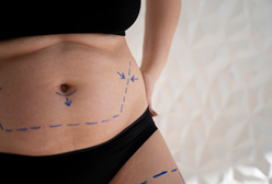 Understanding-Tummy-Tuck-Scars-at-the-3-Yea-Mark