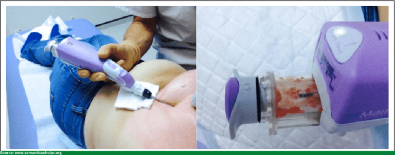 Vacuum-assisted excision biopsy