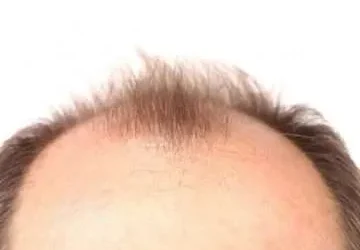 What Are The Reasons For Baldness?