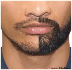 beard hair