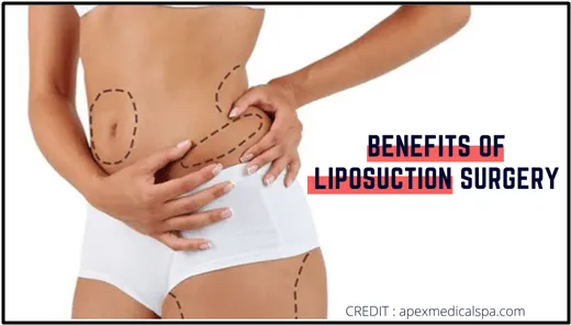 Benefits of liposuction