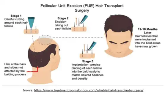 f FUE Hair Transplant