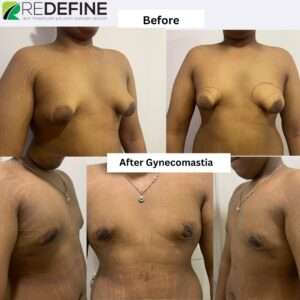 gynecomastia treatment 