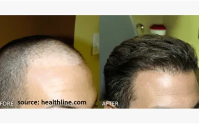 Is hair transplant permanent?