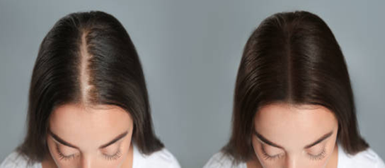 understanding hair thinning in 30s