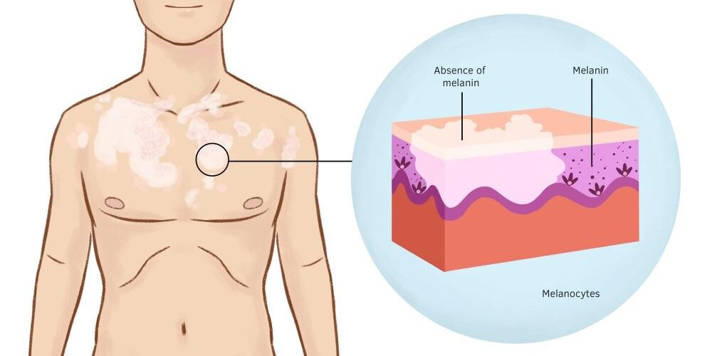 Revolutionary Skin Graft for Vitiligo