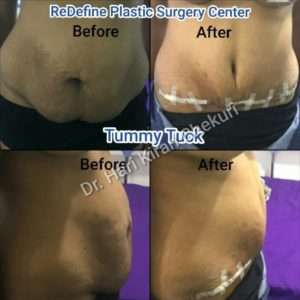 Before & After tummy tuck