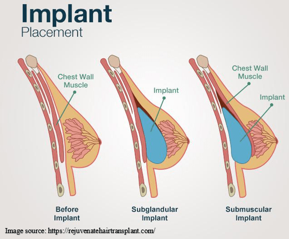 Breast Augmentation Surgery