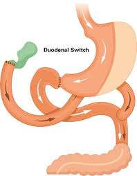 Duodenal switch