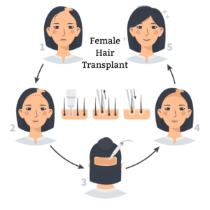 Female hair transplant