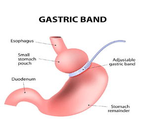 Gastric band