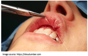 Lip Reduction Surgery