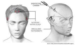 Procedure of Brow Lift