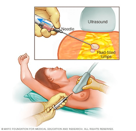 Procedures for Breast Lump Removal