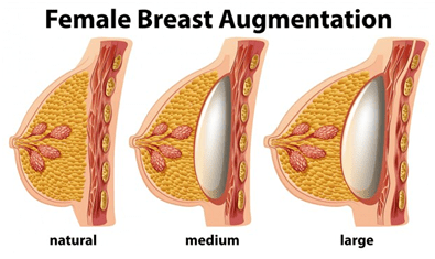 Silicone breast implants