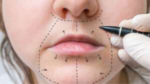 Steps of Lip Reduction