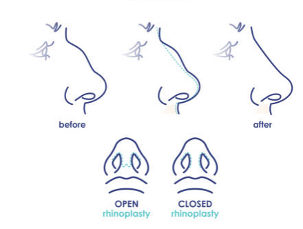 Types of Rhinoplasty