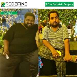 bariatric-sugrery before after