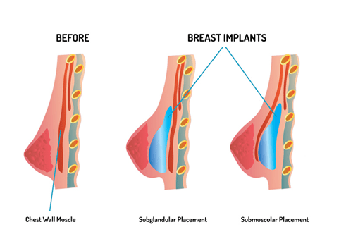 silicone implant treatment