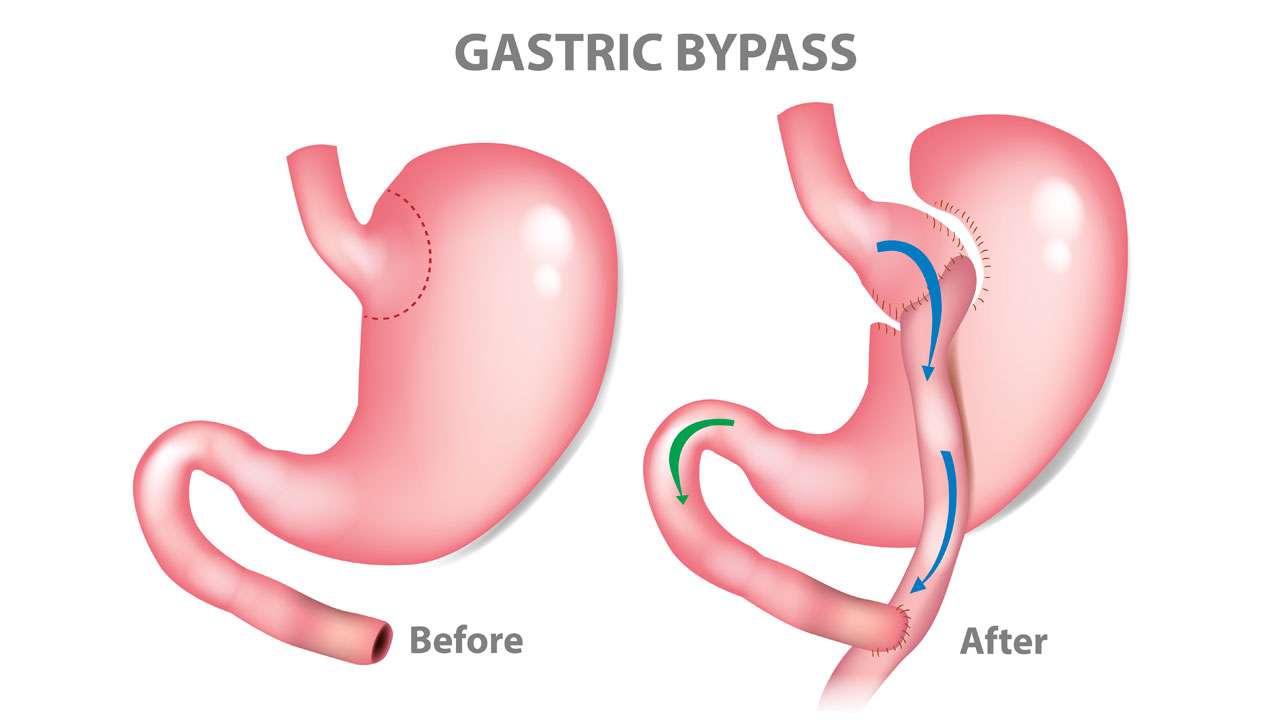 gastric sleeve