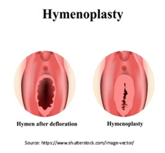 hymenoplasty1