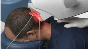 robotic hair transplants