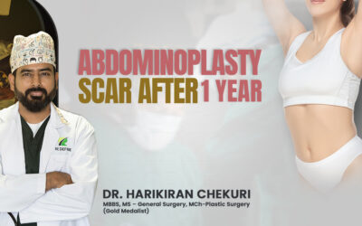 Abdominoplasty scar after 1 year