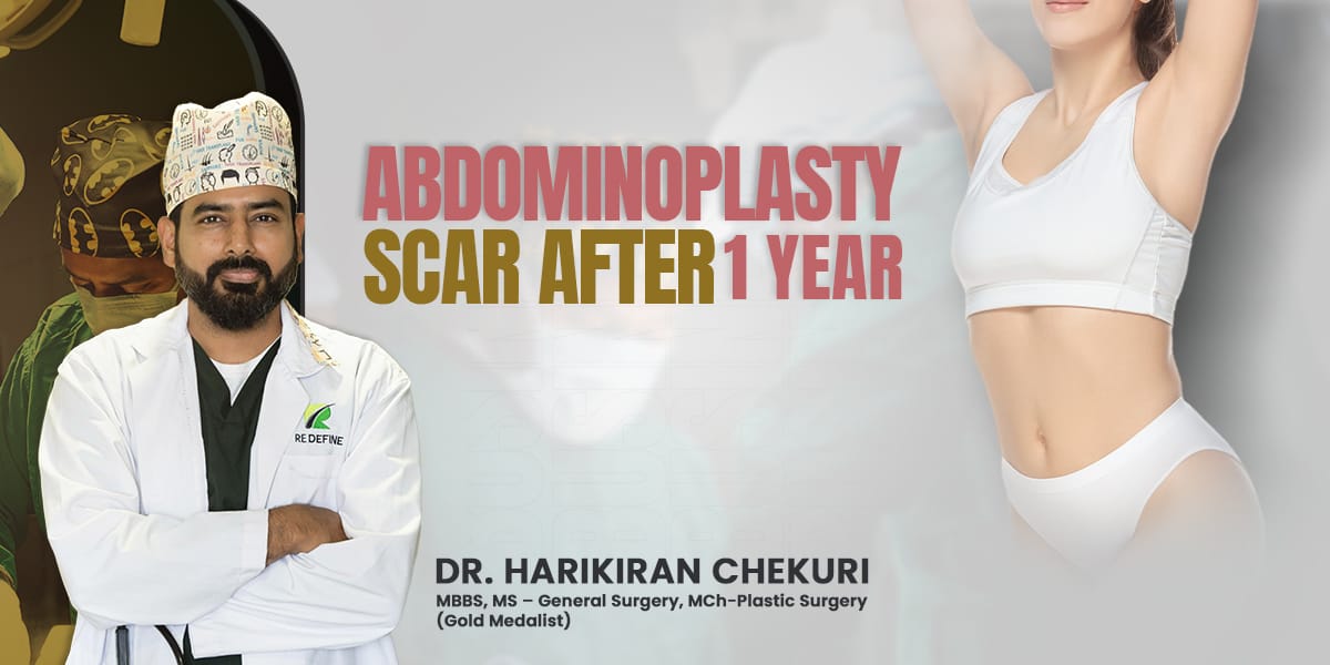 Abdominoplasty scar after 1 year | Redefine How to Use Manjistha for Skin Whitening?