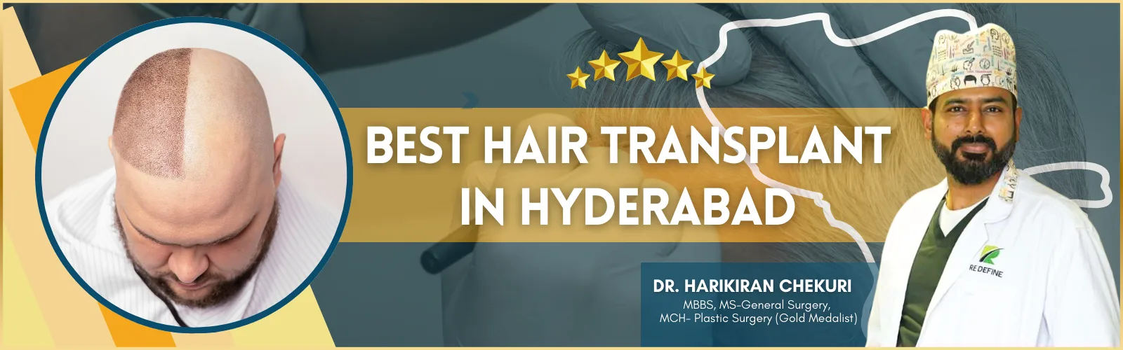 Best Hair Transplant in Hyderabad Best Hair Transplant in Hyderabad