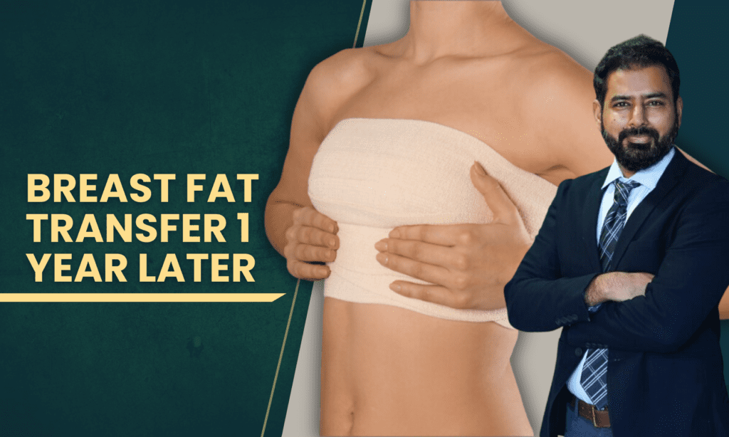 Breast Fat Transfer 1 Year Later