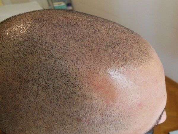 Scalp Micropigmentation