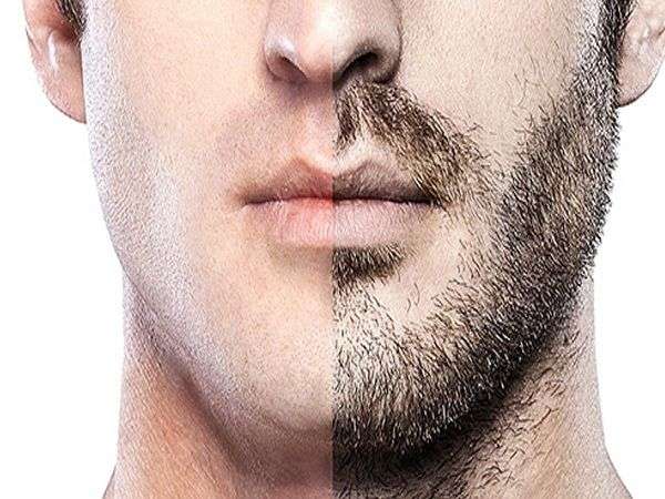 Facial Hair Transplant